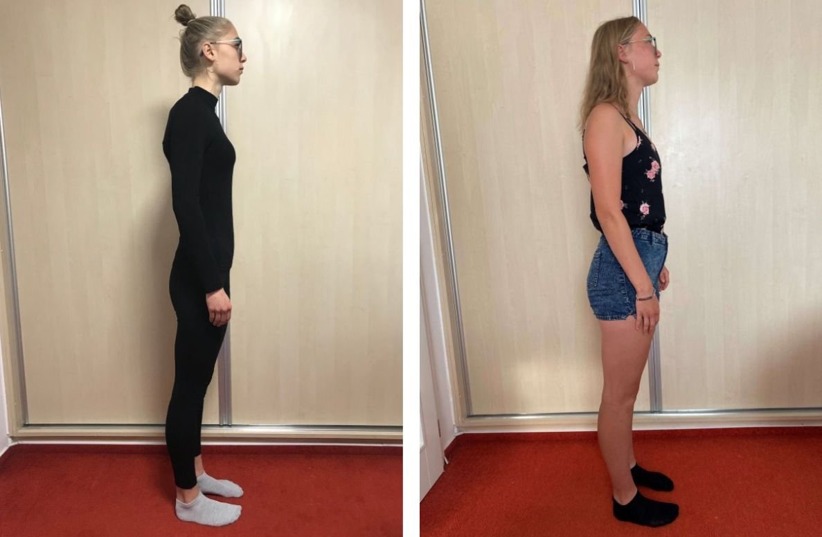 Příběh, jak porazit anorexii - Bára 17 let - foto